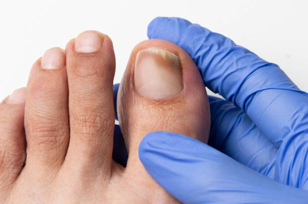 симптомы грибка ногтей на ногах