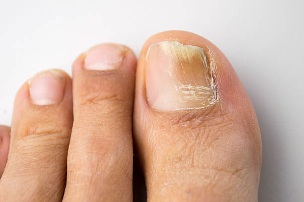 болезнь ногтей на ногах