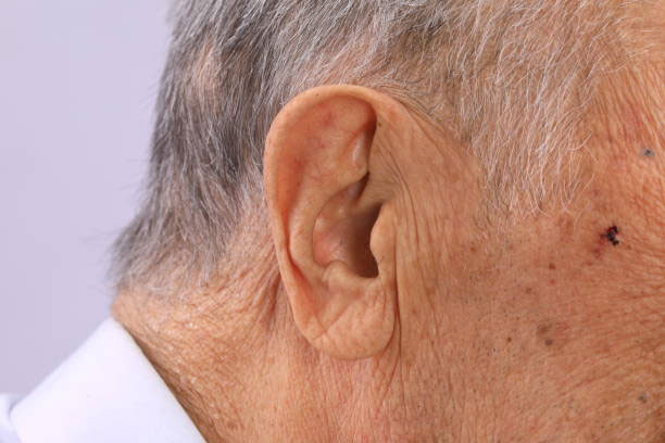 складка мочки уха